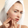 Banishing Blemishes: Effective Tips for Pimple Treatment